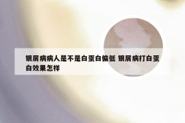 银屑病病人是不是白蛋白偏低 银屑病打白蛋白效果怎样