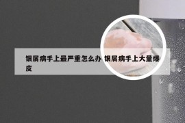 银屑病手上最严重怎么办 银屑病手上大量爆皮