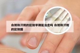 白斑和汗斑的区别早期能治愈吗 白斑和汗斑的区别图