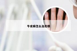 牛皮癣怎么治出根