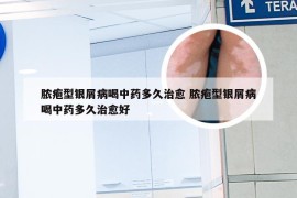 脓疱型银屑病喝中药多久治愈 脓疱型银屑病喝中药多久治愈好