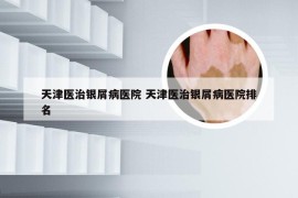 天津医治银屑病医院 天津医治银屑病医院排名