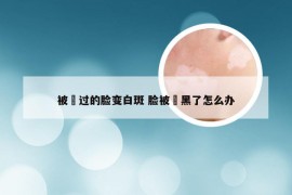 被嗮过的脸变白斑 脸被嗮黑了怎么办