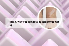 福尔阳光治牛皮癣怎么样 福尔阳光效果怎么样