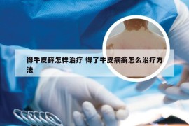 得牛皮藓怎样治疗 得了牛皮病癣怎么治疗方法