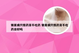 银屑病只擦药膏不吃药 银屑病只擦药膏不吃药会好吗