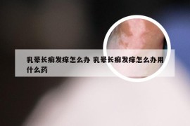 乳晕长癣发痒怎么办 乳晕长癣发痒怎么办用什么药