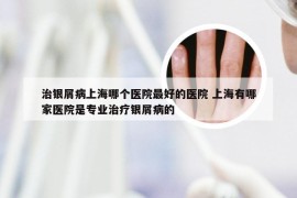 治银屑病上海哪个医院最好的医院 上海有哪家医院是专业治疗银屑病的