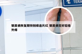 银屑病恢复期特别痒连片红 银屑病见好后格外痒