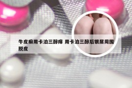 牛皮癣用卡泊三醇痒 用卡泊三醇后银屑周围脱皮