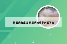 银屑病有疙瘩 银屑病疙瘩多久能下去