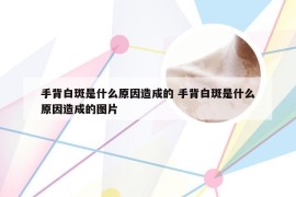 手背白斑是什么原因造成的 手背白斑是什么原因造成的图片