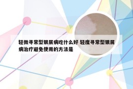 轻微寻常型银屑病吃什么好 轻度寻常型银屑病治疗避免使用的方法是