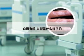 白斑有吗 白斑是什么样子的