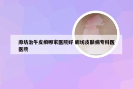 廊坊治牛皮癣哪家医院好 廊坊皮肤病专科医医院