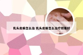 乳头皮癣怎么治 乳头皮癣怎么治疗效果好