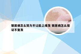 银屑病怎么努力不让脸上爆发 银屑病怎么保证不复发