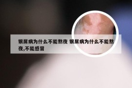 银屑病为什么不能熬夜 银屑病为什么不能熬夜,不能感冒