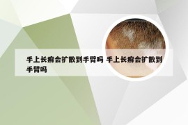 手上长癣会扩散到手臂吗 手上长癣会扩散到手臂吗