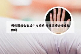 慢性湿疹会变成牛皮癣吗 慢性湿疹会变皮肤癌吗