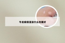 牛皮癣保湿涂什么效果好