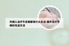 外国人治疗牛皮癣都用什么办法 国外治疗牛癣的先进方法