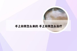 手上白斑怎么来的 手上白斑怎么治疗