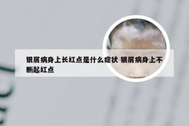 银屑病身上长红点是什么症状 银屑病身上不断起红点