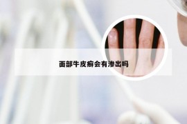 面部牛皮癣会有渗出吗