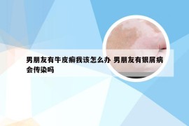 男朋友有牛皮癣我该怎么办 男朋友有银屑病会传染吗