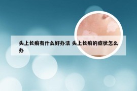 头上长癣有什么好办法 头上长癣的症状怎么办