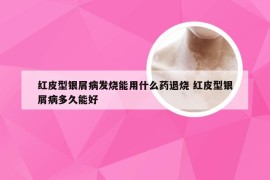 红皮型银屑病发烧能用什么药退烧 红皮型银屑病多久能好