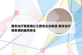 西安治疗银屑病公立西安北方精湛 西安治疗银屑病的医院排名