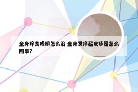 全身痒变成癣怎么治 全身发痒起皮疹是怎么回事?