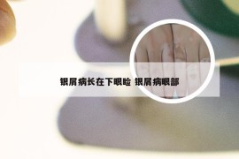 银屑病长在下眼睑 银屑病眼部