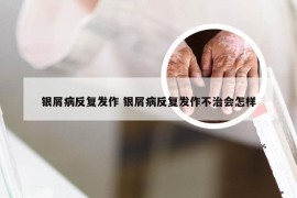 银屑病反复发作 银屑病反复发作不治会怎样