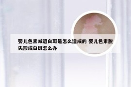 婴儿色素减退白斑是怎么造成的 婴儿色素脱失形成白斑怎么办