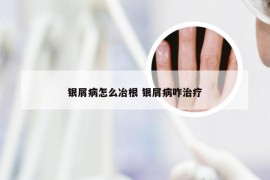 银屑病怎么冶根 银屑病咋治疗