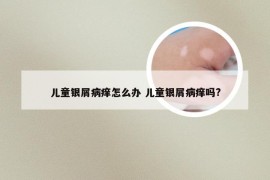 儿童银屑病痒怎么办 儿童银屑病痒吗?