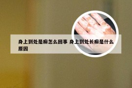 身上到处是癣怎么回事 身上到处长癣是什么原因