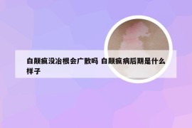 白颠疯没冶根会广散吗 白颠疯病后期是什么样子