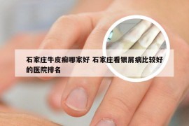 石家庄牛皮癣哪家好 石家庄看银屑病比较好的医院排名