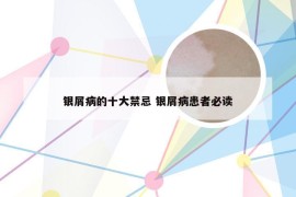 银屑病的十大禁忌 银屑病患者必读