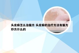 头皮癣怎么治偏方 头皮癣的治疗方法有偏方妙方什么的