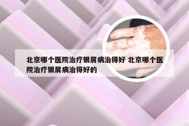 北京哪个医院治疗银屑病治得好 北京哪个医院治疗银屑病治得好的