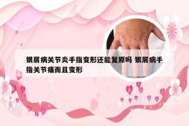 银屑病关节炎手指变形还能复原吗 银屑病手指关节痛而且变形