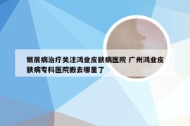 银屑病治疗关注鸿业皮肤病医院 广州鸿业皮肤病专科医院搬去哪里了