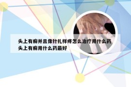 头上有癣并且像针扎样疼怎么治疗用什么药 头上有癣用什么药最好