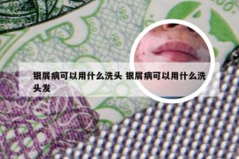 银屑病可以用什么洗头 银屑病可以用什么洗头发