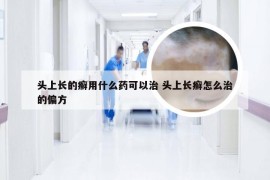 头上长的癣用什么药可以治 头上长癣怎么治的偏方